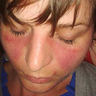 Patients with Lupus often show rashes on their skin. Credit: [Wikimedia](https://commons.wikimedia.org/wiki/File:Lupusfoto.jpg).