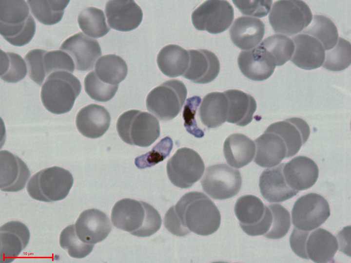 The malaria causing parasite (purple) in-between human red blood cells. Credit: [Wikimedia](https://commons.wikimedia.org/wiki/File:P.falciparum-gametocytes.jpg).
