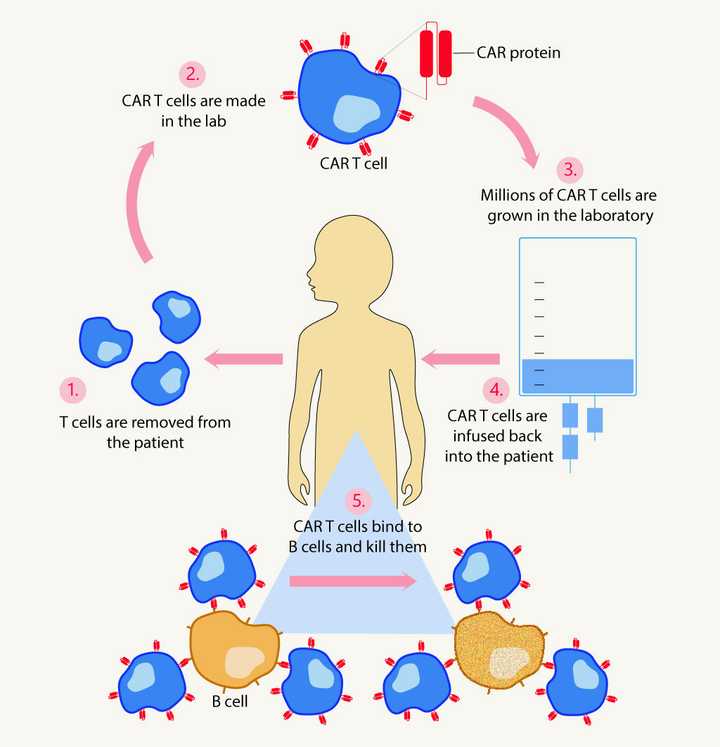 Steps involved in CAR T cell therapy: Step 1 – T cells are extracted from the patient. Step 2 – T cells are genetically modified so that they make a protein called the chimeric antigen receptor (CAR) protein on their cell surface. Step 3 – Millions of these CAR T cells are grown in the lab. Step 4 – These CAR T cells are infused back into the patient. Step 5 – CAR T cells specifically bind the B cells and kill them. © Sunaina Rao.