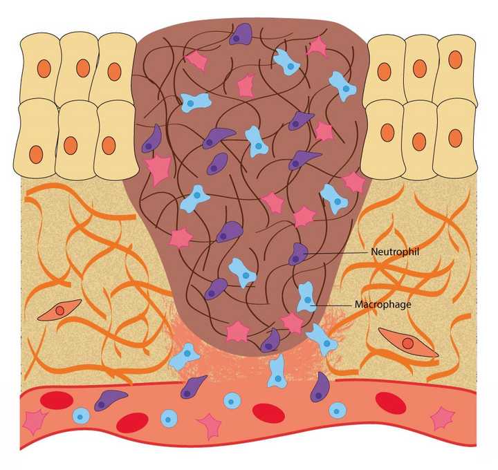In the inflammatory phase, macrophages and neutrophils enter the wound area and kill any infectious agents like bacteria and fungi. © Sunaina Rao